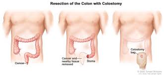 Anal Cancer: Causes, Treatment, and Cost in India