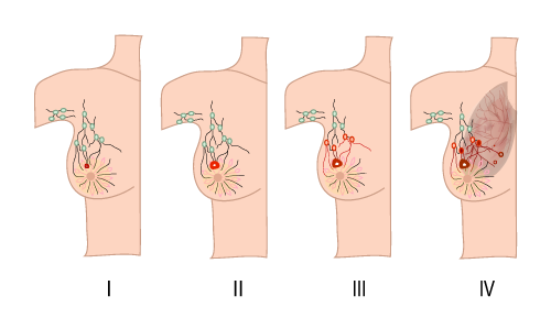 Best Breast Cancer Treatment in India | Cost, Hospitals & Specialists Guide