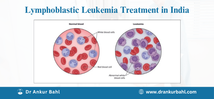 Acute Lymphoblastic Leukemia (ALL) Treatment in India