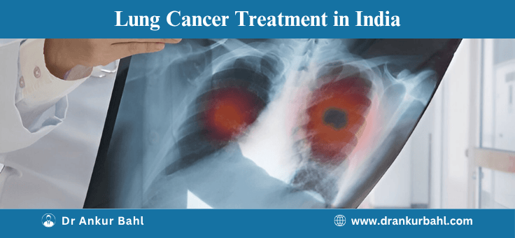 Lung Cancer Treatment Cost in India