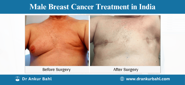 Male Breast Cancer Treatment in India
