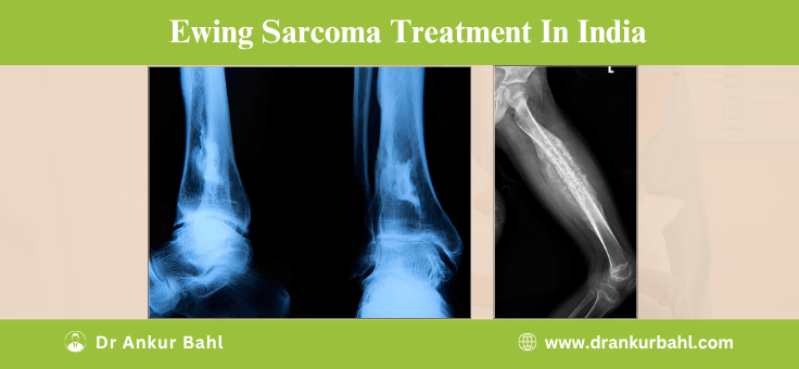 Ewing Sarcoma Treatment Cost in India
