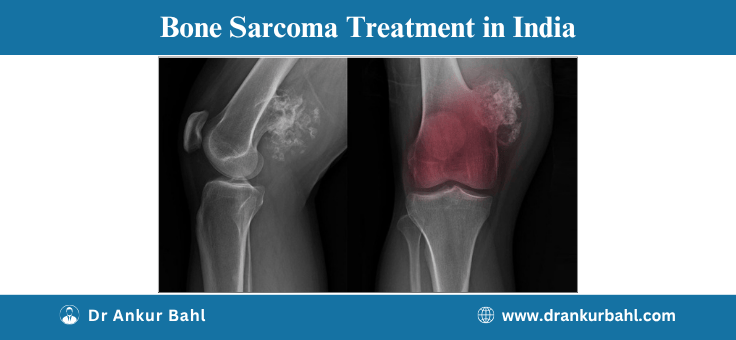 Bone Sarcoma Treatment in India