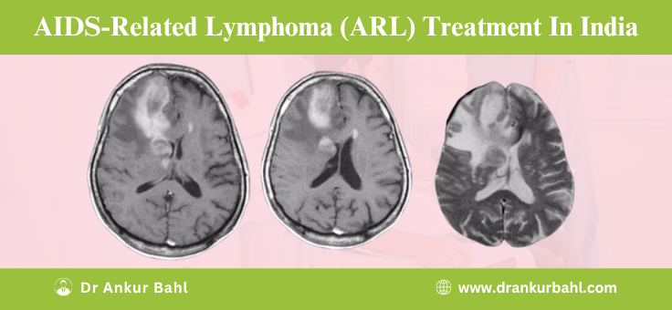 AIDS-Related Lymphoma (ARL) Treatment in India