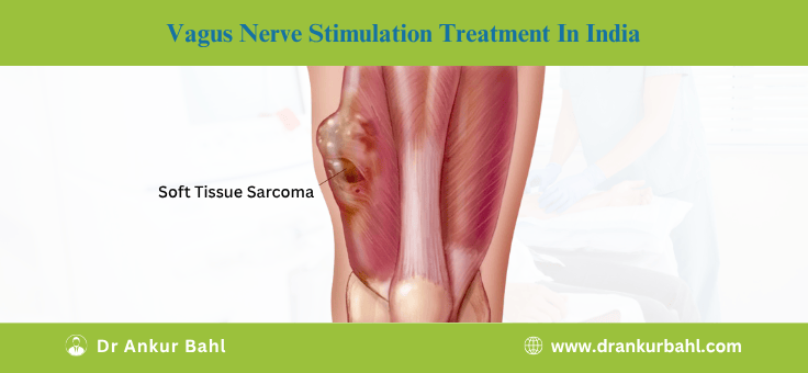 Soft Tissue Sarcoma Treatment in India