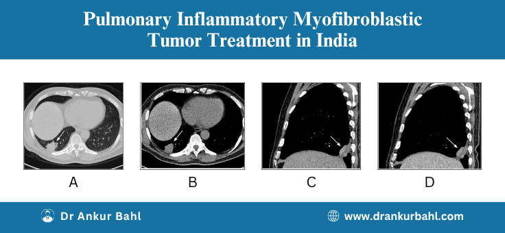 Pulmonary Inflammatory Myofibroblastic Tumor Treatment in India