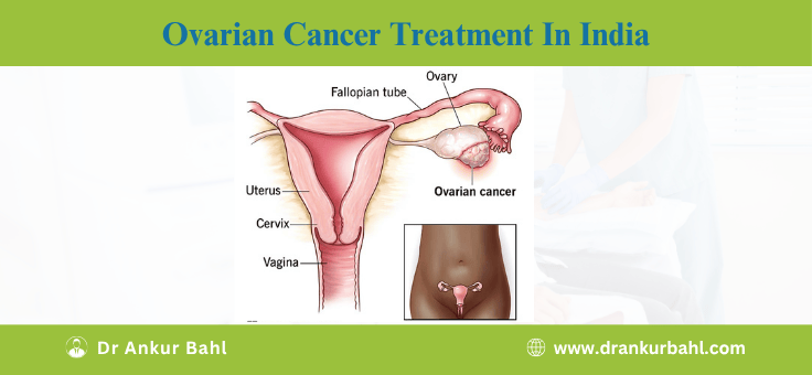 Ovarian Cancer Treatment Cost in India