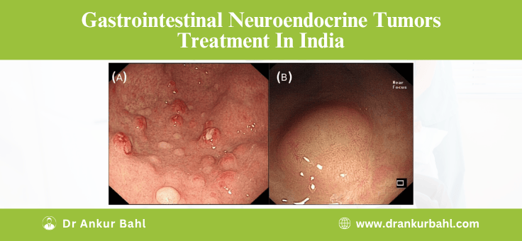 Neuroendocrine Tumor GI Treatment in India