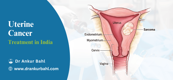 Endometrial (Uterine) Cancer Treatment in India
