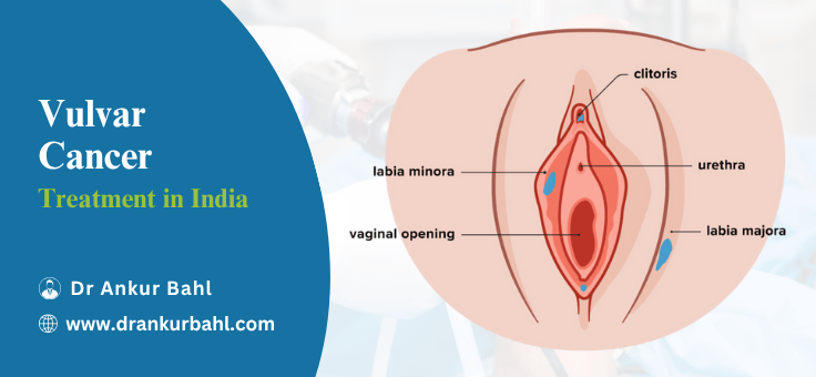 Vulvar Cancer Treatment in India