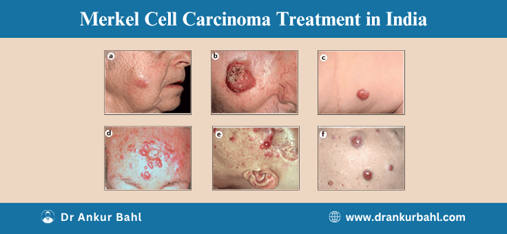 Merkel Cell Carcinoma Treatment in India