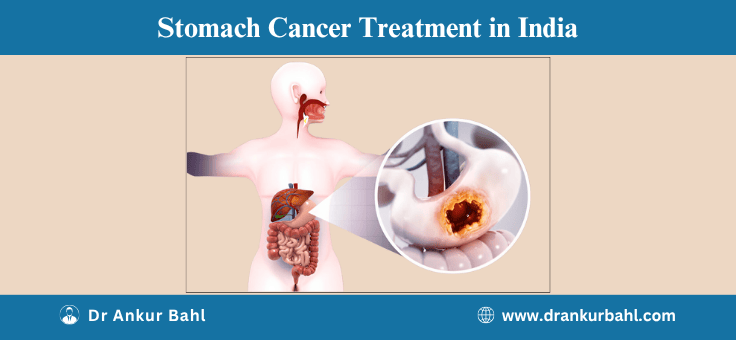 Gastric (Stomach) Cancer Treatment in India