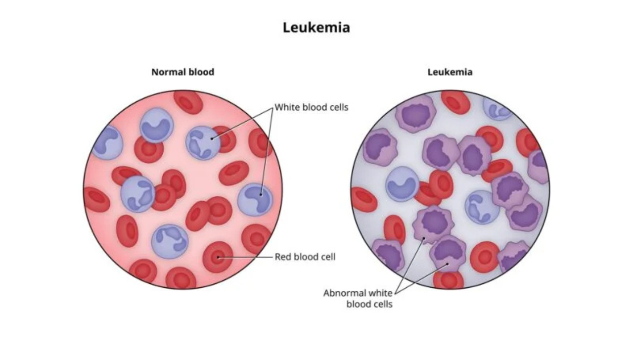 Acute Lymphoblastic Leukemia (ALL) Treatment in India
